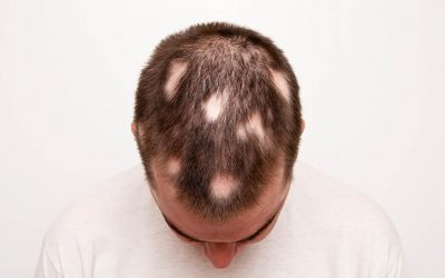 Remèdes naturels conseillés pour la pelade