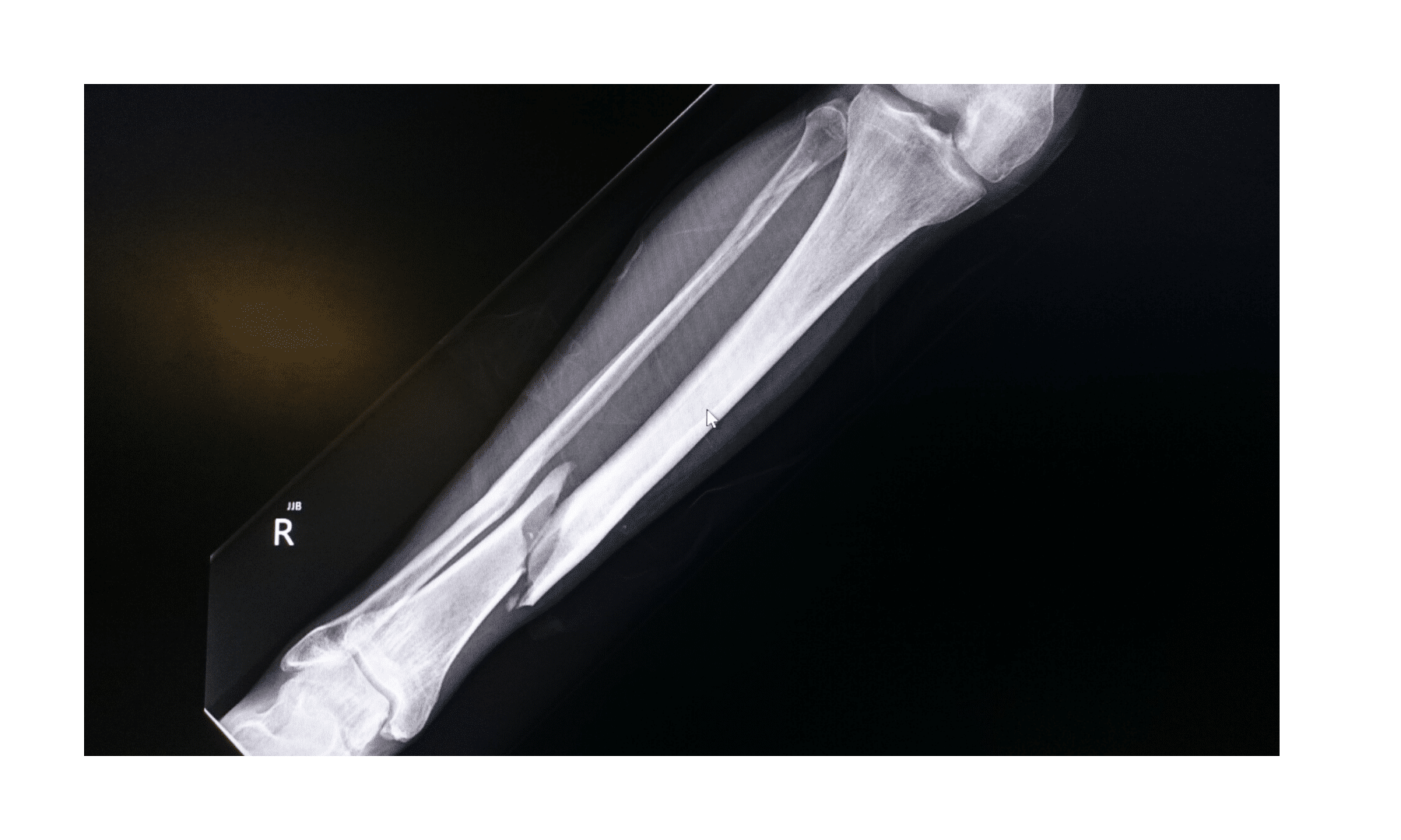 Consolider les os après une fracture